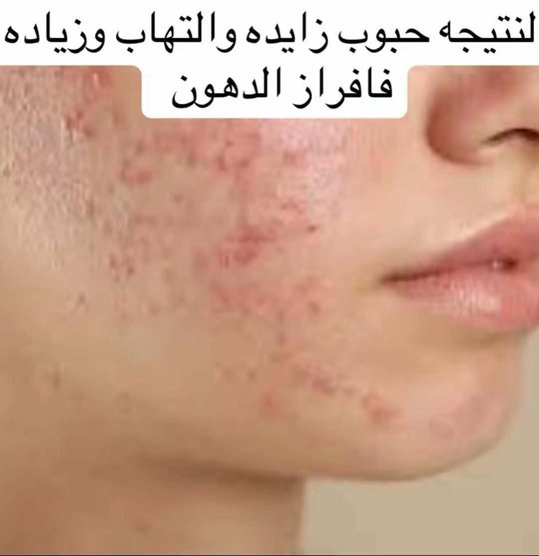 أسباب حب الشباب
