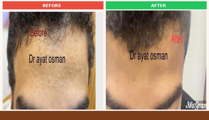 علاج حب الشباب وآثاره