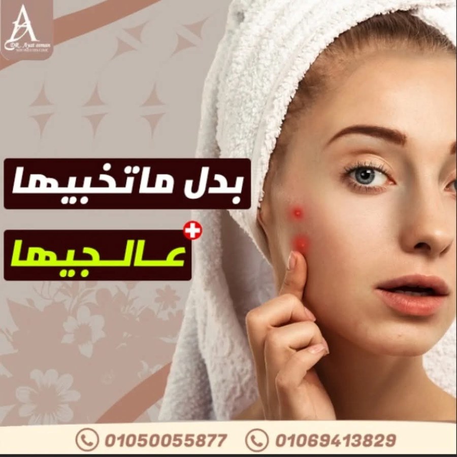 علاج حب الشباب والآثار