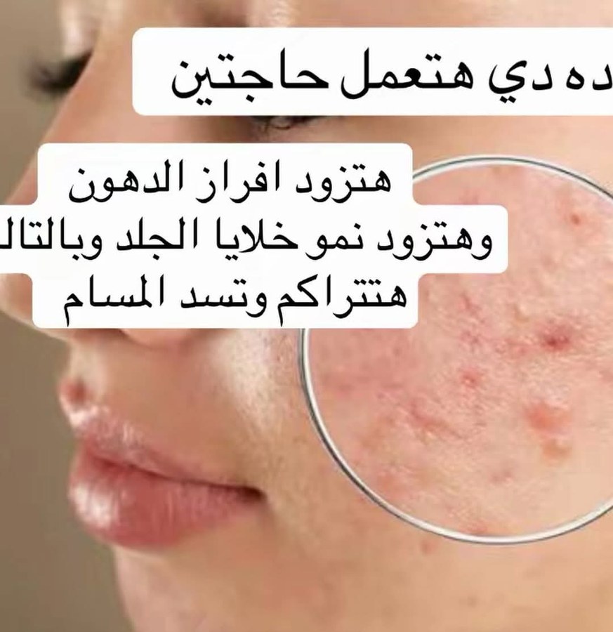 فيلر شفايف